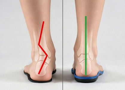 Ortesis vs plantillas: diferencias clave, beneficios y mejor opción